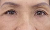Lower eyelid surgery ѧ 7 ѹ