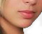 Chin Augmentation surgery in Bangkok