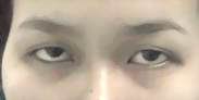 Double eyelid surgery non incision. Before