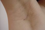 Incision of breast augmentation surgey 1 week