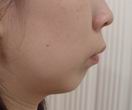 Chin augmentation surgery before