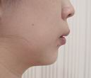 Chin augmentation surgery. after 1 week