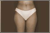 Lipoplasty BEFORE