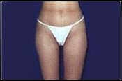 Lipoplasty AFTER