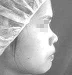 Rhinoplasty BEFORE