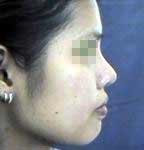 Rhinoplasty ѧ١ 7 ѹ