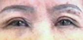 upper eyelid surgery after 7 days